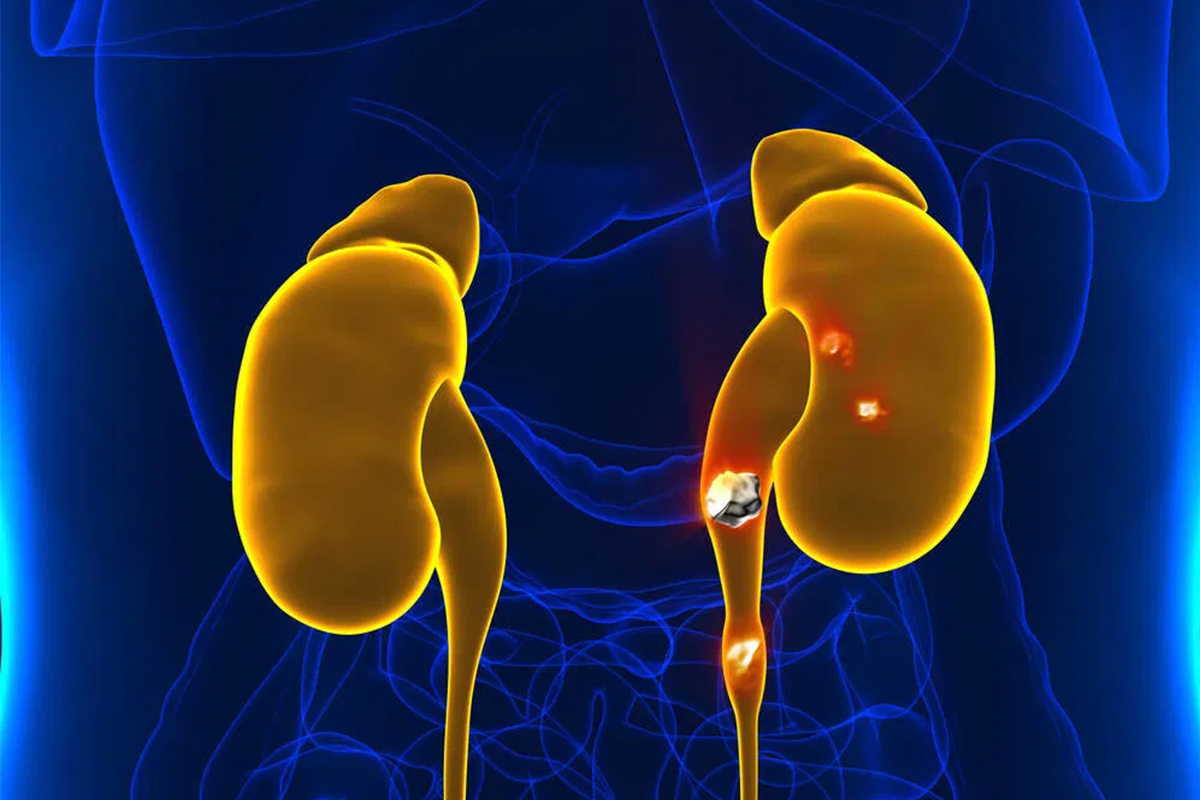 Read more about the article 3 Simple behaviours to prevent kidney stones in Singapore