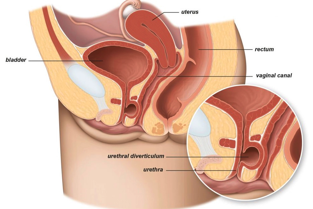 Read more about the article Urethral Diverticulum