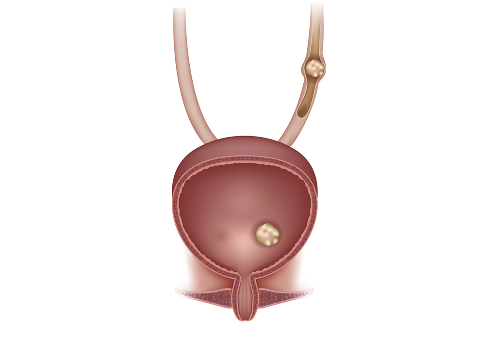 Read more about the article Bladder Stone Treatment