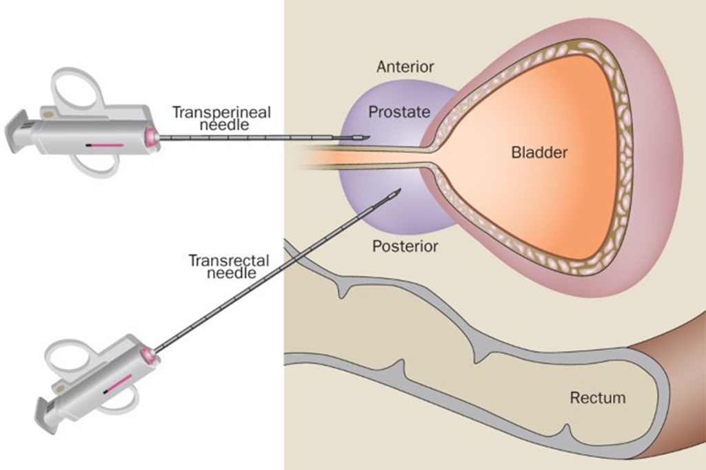 Read more about the article Prostate biopsy: Transperineal or transrectal?