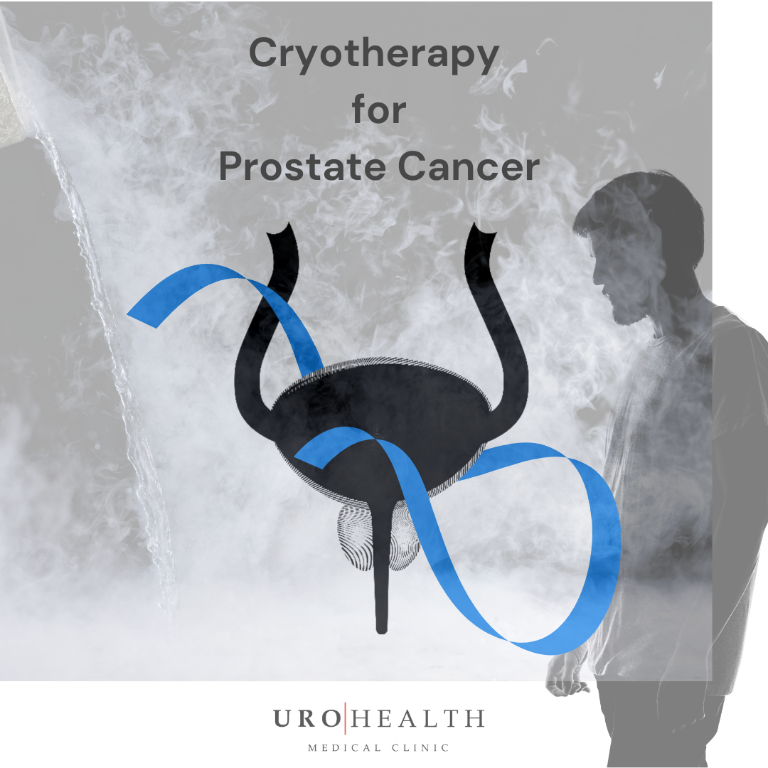 Read more about the article What is cryotherapy for prostate cancer?